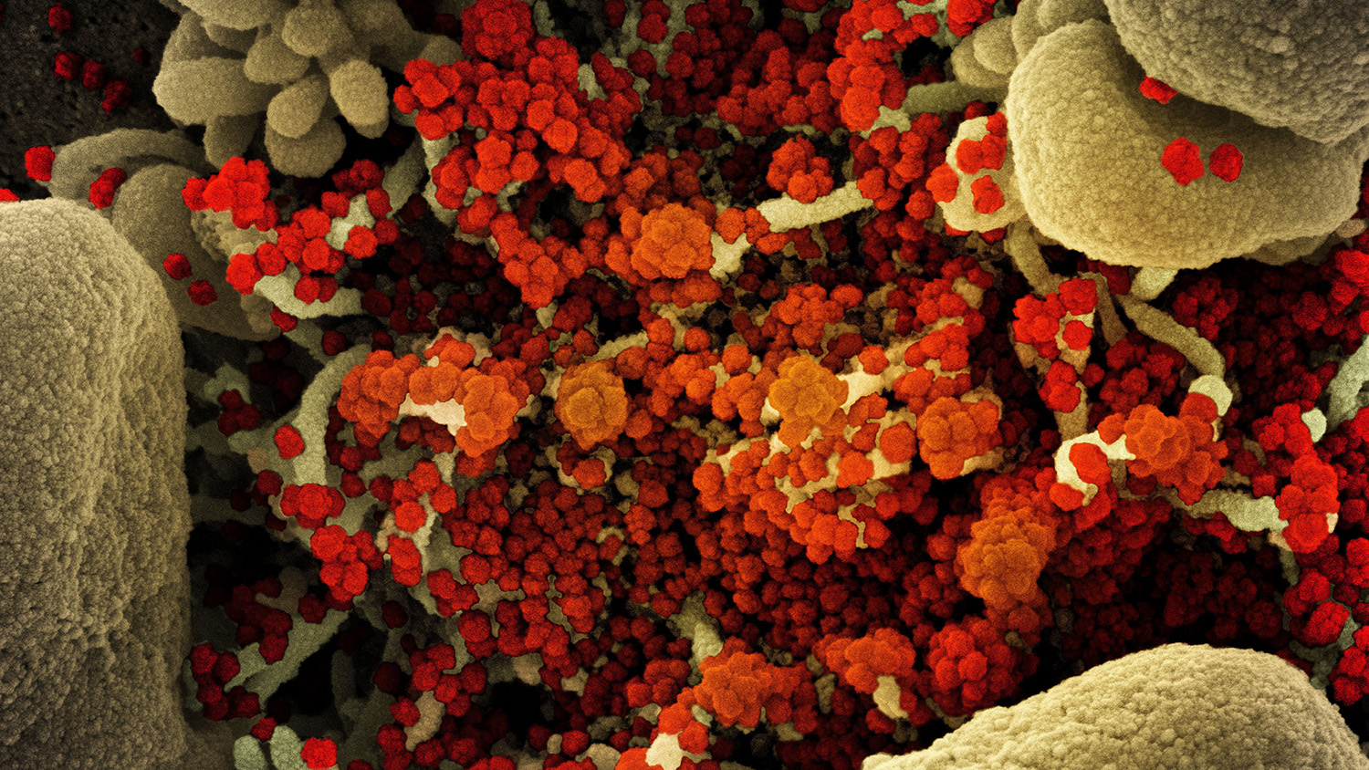 Colorized scanning electron micrograph of an apoptotic cell (tan) heavily infected with SARS-CoV-2 virus particles (orange).